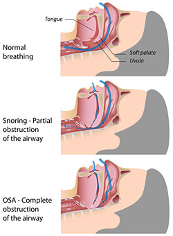 sleep apnea treatment